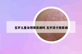 五岁儿童会得银屑病吗 五岁孩子银屑病