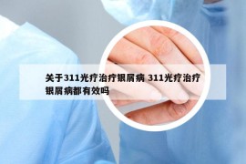 关于311光疗治疔银屑病 311光疗治疗银屑病都有效吗