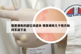 银屑病有的部位消退快 银屑病有几个地方始终不消下去