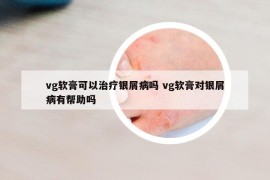vg软膏可以治疗银屑病吗 vg软膏对银屑病有帮助吗