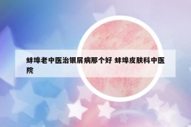 蚌埠老中医治银屑病那个好 蚌埠皮肤科中医院