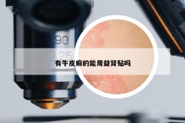 有牛皮癣的能用益肾贴吗