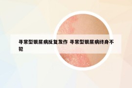 寻常型银屑病反复发作 寻常型银屑病终身不犯