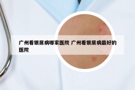 广州看银屑病哪家医院 广州看银屑病最好的医院
