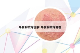 牛皮癣按摩图解 牛皮癣按摩哪里