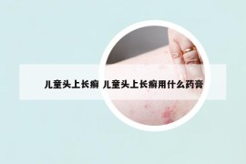 儿童头上长癣 儿童头上长癣用什么药膏