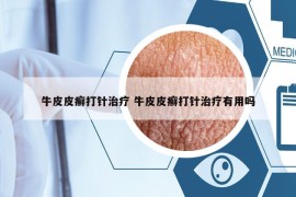 牛皮皮癣打针治疗 牛皮皮癣打针治疗有用吗