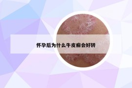 怀孕后为什么牛皮癣会好转