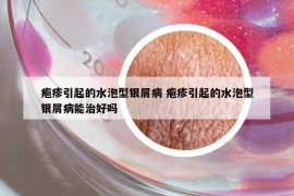疱疹引起的水泡型银屑病 疱疹引起的水泡型银屑病能治好吗