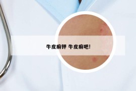 牛皮癣钾 牛皮癣吧!