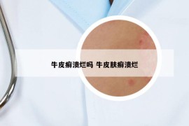 牛皮癣溃烂吗 牛皮肤癣溃烂