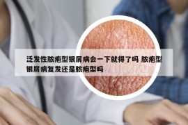 泛发性脓疱型银屑病会一下就得了吗 脓疱型银屑病复发还是脓疱型吗