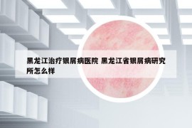 黑龙江治疗银屑病医院 黑龙江省银屑病研究所怎么样
