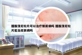 醋酸泼尼松片可以治疗银屑病吗 醋酸泼尼松片能治皮肤病吗