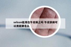 selsun能用在牛皮癣上吗 牛皮肤癣可以用硫磺皂么