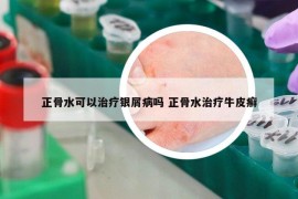 正骨水可以治疗银屑病吗 正骨水治疗牛皮癣