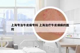 上海专治牛皮癣专科 上海治疗牛皮病癣的医院