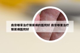 南京哪家治疗银屑病的医院好 南京哪里治疗银屑病医院好