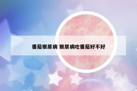 番茄银屑病 银屑病吃番茄好不好