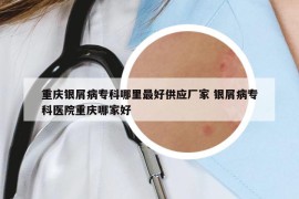 重庆银屑病专科哪里最好供应厂家 银屑病专科医院重庆哪家好