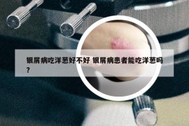 银屑病吃洋葱好不好 银屑病患者能吃洋葱吗?
