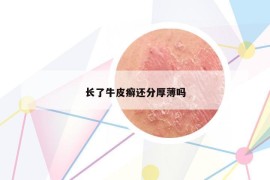 长了牛皮癣还分厚薄吗
