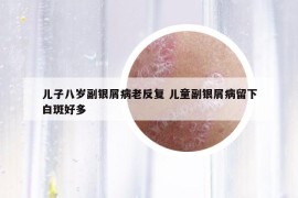 儿子八岁副银屑病老反复 儿童副银屑病留下白斑好多