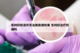 甘利欣和清开灵治银屑病效果 甘利欣治疗肝病吗