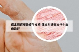 保定附近哪治疗牛皮癣 保定附近哪治疗牛皮癣最好