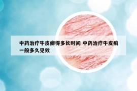 中药治疗牛皮癣得多长时间 中药治疗牛皮癣一般多久见效