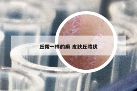 丘陵一样的癣 皮肤丘陵状