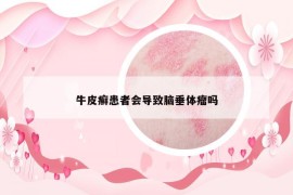 牛皮癣患者会导致脑垂体瘤吗