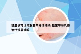 银屑病可以用联苯苄唑溶液吗 联苯苄唑乳膏治疗银屑病吗