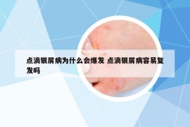 点滴银屑病为什么会爆发 点滴银屑病容易复发吗