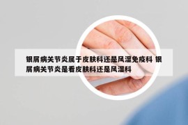银屑病关节炎属于皮肤科还是风湿免疫科 银屑病关节炎是看皮肤科还是风湿科