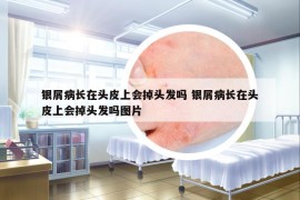 银屑病长在头皮上会掉头发吗 银屑病长在头皮上会掉头发吗图片