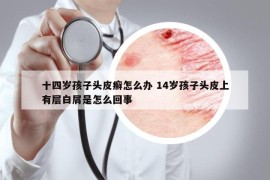 十四岁孩子头皮癣怎么办 14岁孩子头皮上有层白屑是怎么回事
