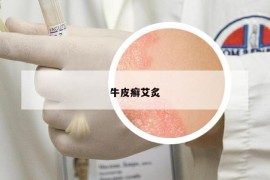 牛皮癣艾炙