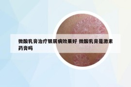 微酸乳膏治疗银屑病效果好 微酸乳膏是激素药膏吗