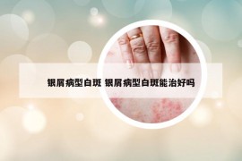银屑病型白斑 银屑病型白斑能治好吗
