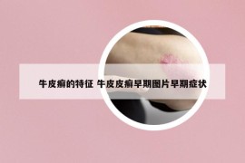 牛皮癣的特征 牛皮皮癣早期图片早期症状