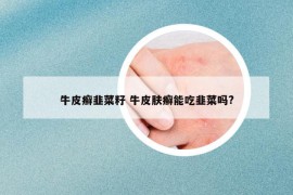 牛皮癣韭菜籽 牛皮肤癣能吃韭菜吗?