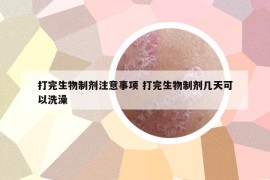 打完生物制剂注意事项 打完生物制剂几天可以洗澡