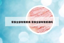家族全部有银屑病 家族全部有银屑病吗