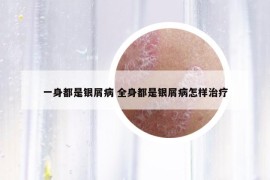 一身都是银屑病 全身都是银屑病怎样治疗