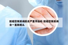 脓疱型银屑病脱皮严重传染吗 脓疱型银屑病会一直脓疱么