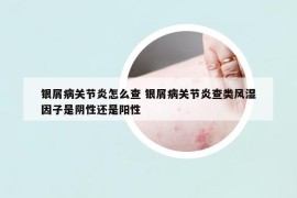 银屑病关节炎怎么查 银屑病关节炎查类风湿因子是阴性还是阳性