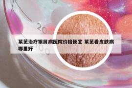 莱芜治疗银屑病医院价格便宜 莱芜看皮肤病哪里好