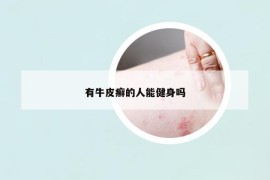 有牛皮癣的人能健身吗
