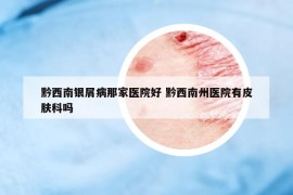 黔西南银屑病那家医院好 黔西南州医院有皮肤科吗